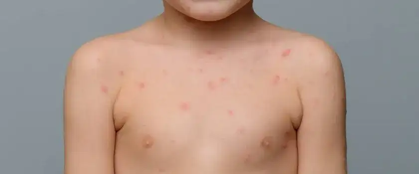 Kiedy do lekarza przy ospie? Kluczowe objawy, które musisz znać