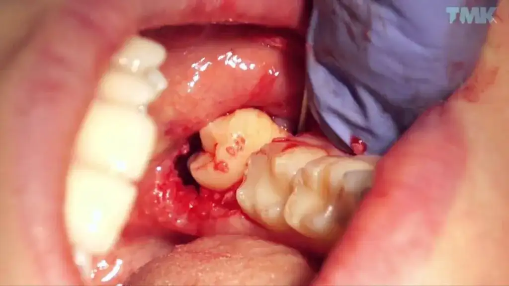 Ból po wyrwaniu zęba: Kiedy jest normalny, a kiedy do dentysty?