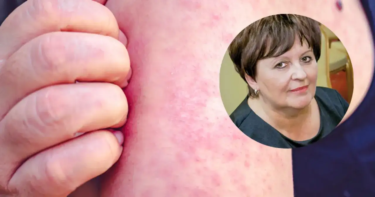 Dłoń drapiąca zaczerwienioną skórę z wysypką. W tle kobieta, być może cierpiąca na tę chorobę.