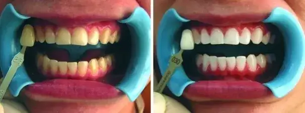 Jak wygląda wybielanie zębów u dentysty? Poznaj szczegóły i efekty