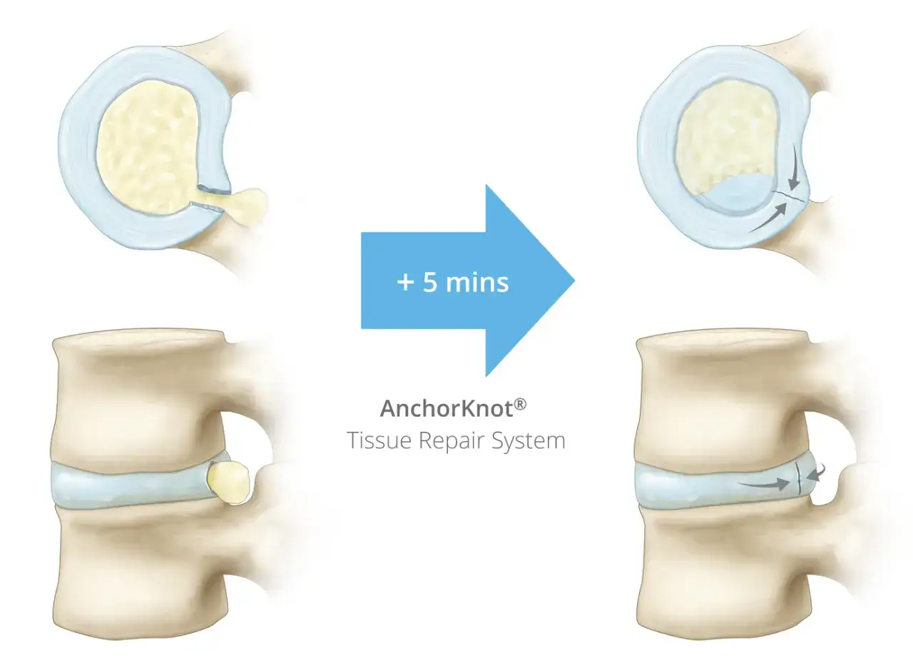 Skuteczne metody leczenia uszkodzenia pierścienia włóknistego