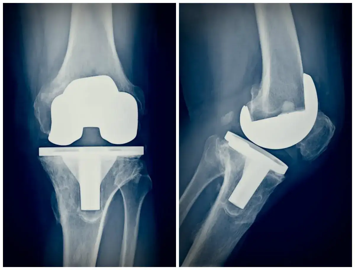 Jakie badania przed endoprotezą kolana? Lista i zalecenia przed operacją
