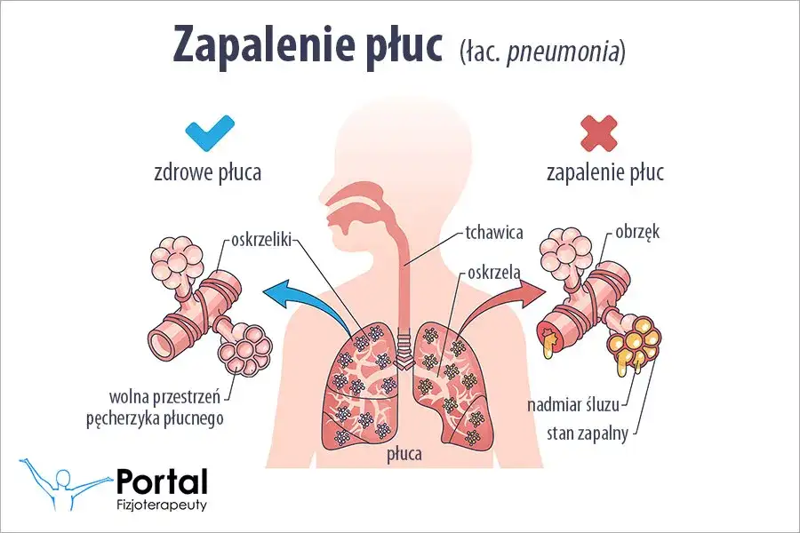 7 najgroźniejszych objawów zapalenia płuc, które musisz rozpoznać szybko