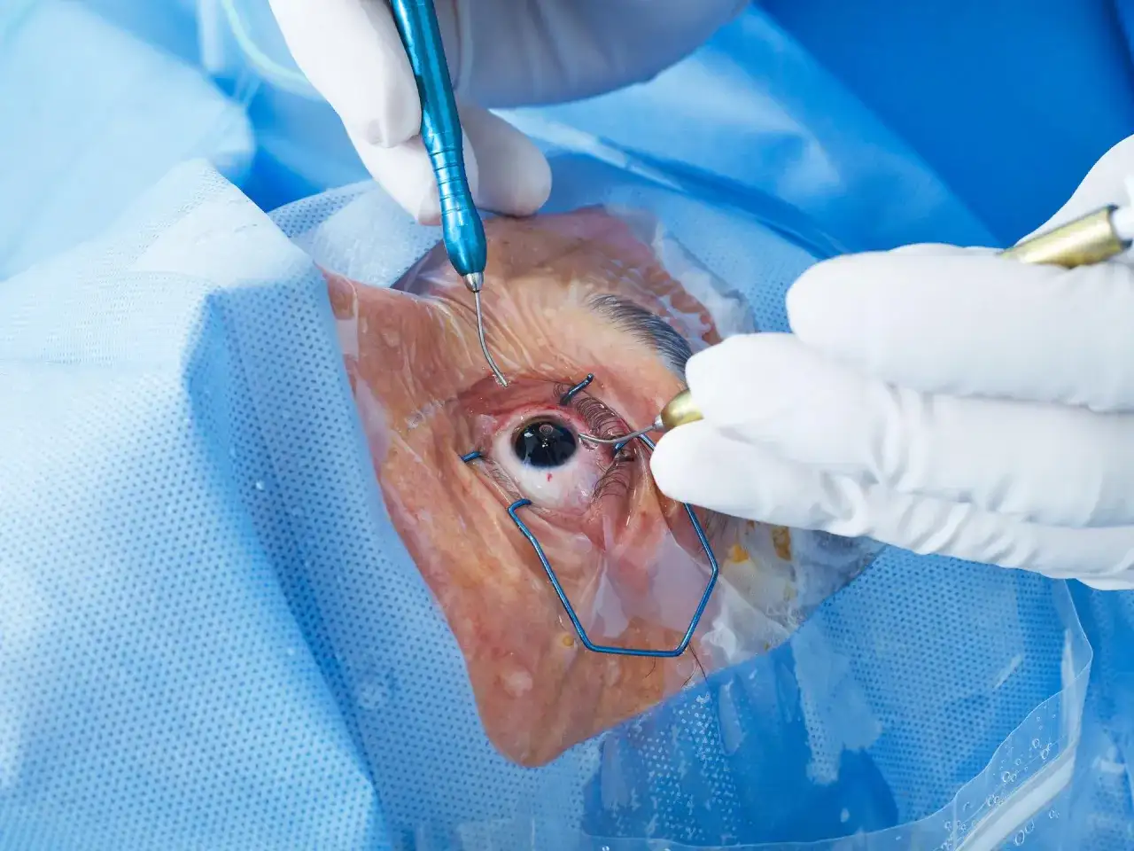 Objawy zaćmy: jak je rozpoznać i kiedy udać się do lekarza