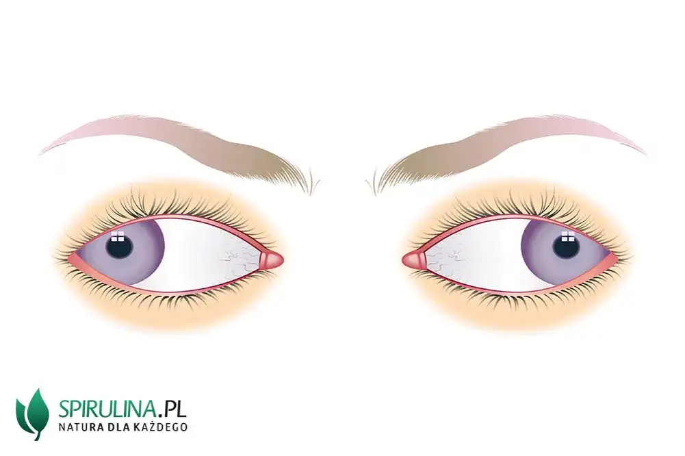 Co to jest zez rozbieżny? Objawy, przyczyny i skuteczne leczenie