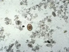 Tłuszcz w kale: Co oznacza i jak go rozpoznać? 6 ważnych wskazówek