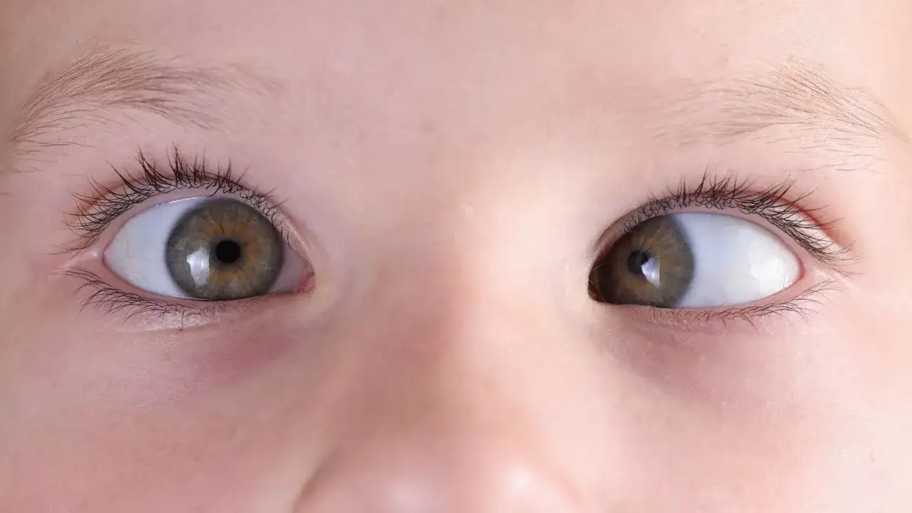 Jak skutecznie leczyć zez? Sprawdzone metody i porady dla Ciebie