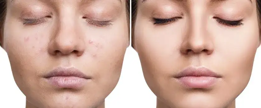 Skuteczne sposoby na wybielenie czerwonych plam po pryszczach