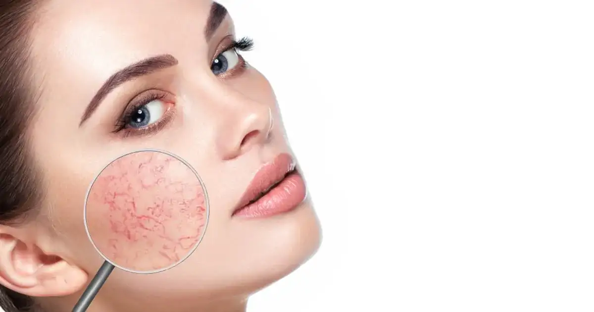 Jak skutecznie dbać o cerę naczynkową i uniknąć pogorszenia jej stanu