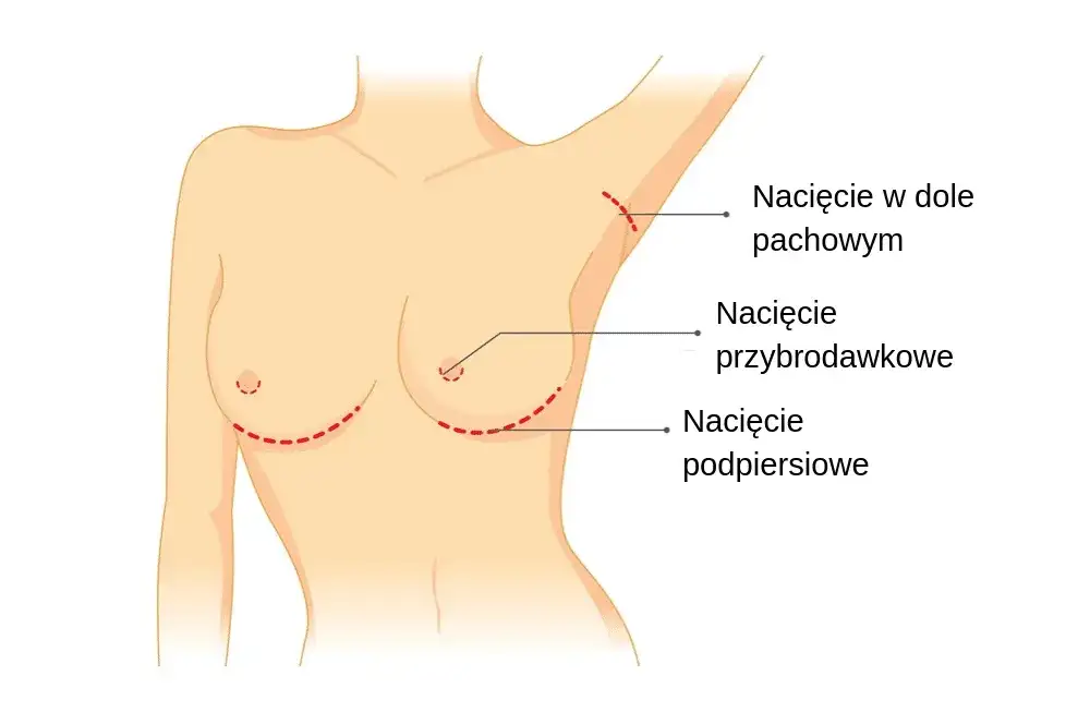 Gdzie zrobić operację biustu? Znajdź najlepsze kliniki w Polsce