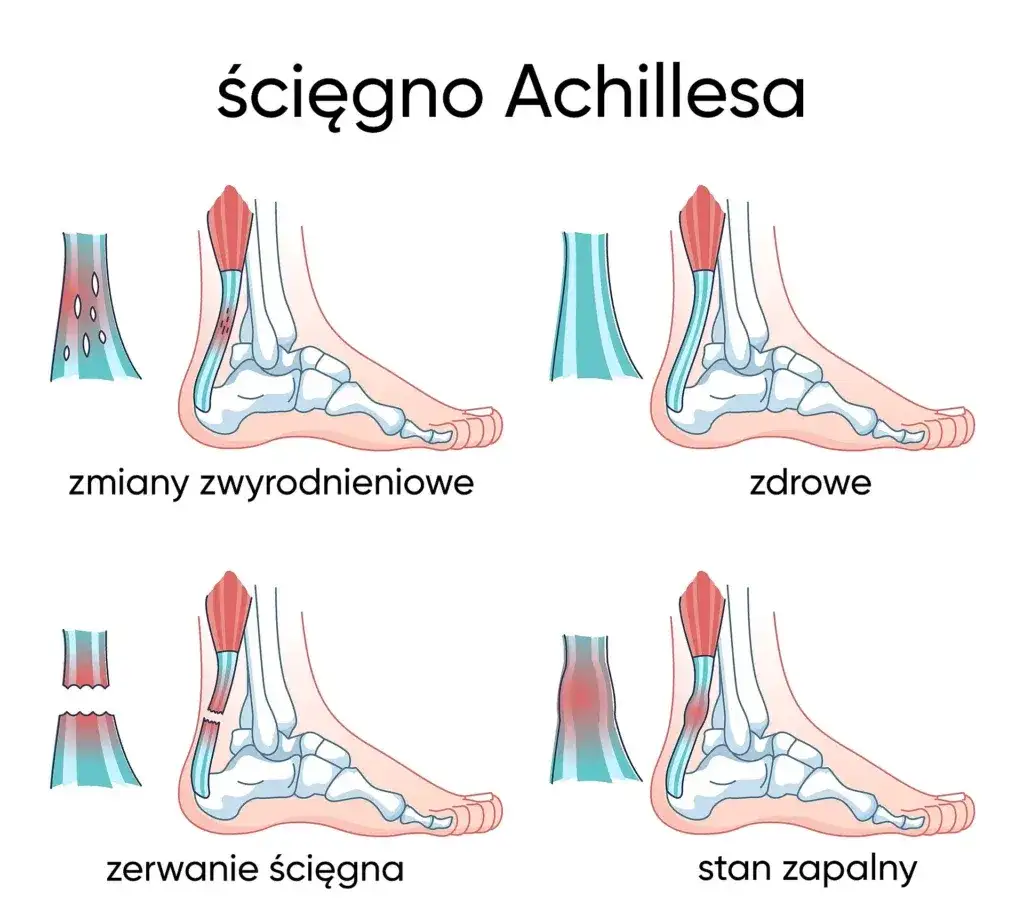 Najczęstsze objawy naciągnięcia ścięgna Achillesa: rozpoznaj kontuzję