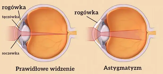 Czy astygmatyzm może się zmniejszyć? Poznaj prawdę o leczeniu i wieku