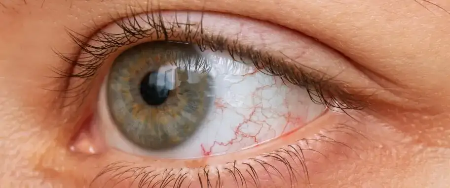 Przekrwione oczy przyczyny – jakie mogą być poważne skutki?