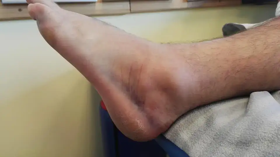 Jak długo utrzymuje się opuchlizna po skręceniu kostki i co robić?