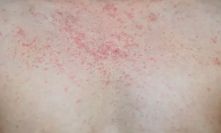 Rumień zakaźny objawy: jakie sygnały mogą wskazywać na chorobę?