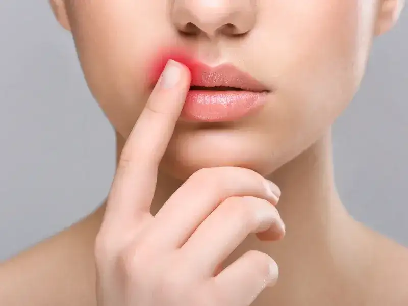 Najlepsza maść na opryszczkę: Skuteczne rozwiązania na szybkie pozbycie się problemu