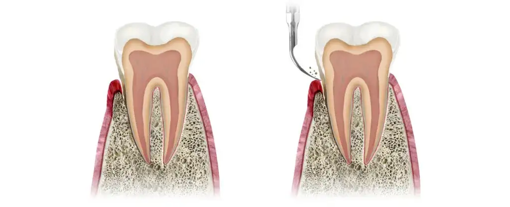 Jak skutecznie wyciągnąć ropę z dziąsła i uniknąć bólu