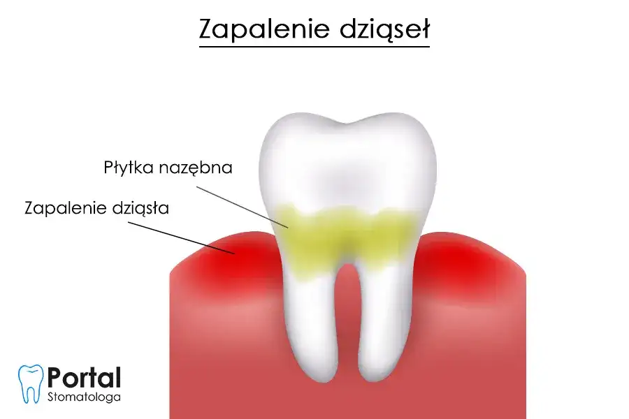 Zapalenie dziąseł? Jak skutecznie leczyć w domu i u dentysty