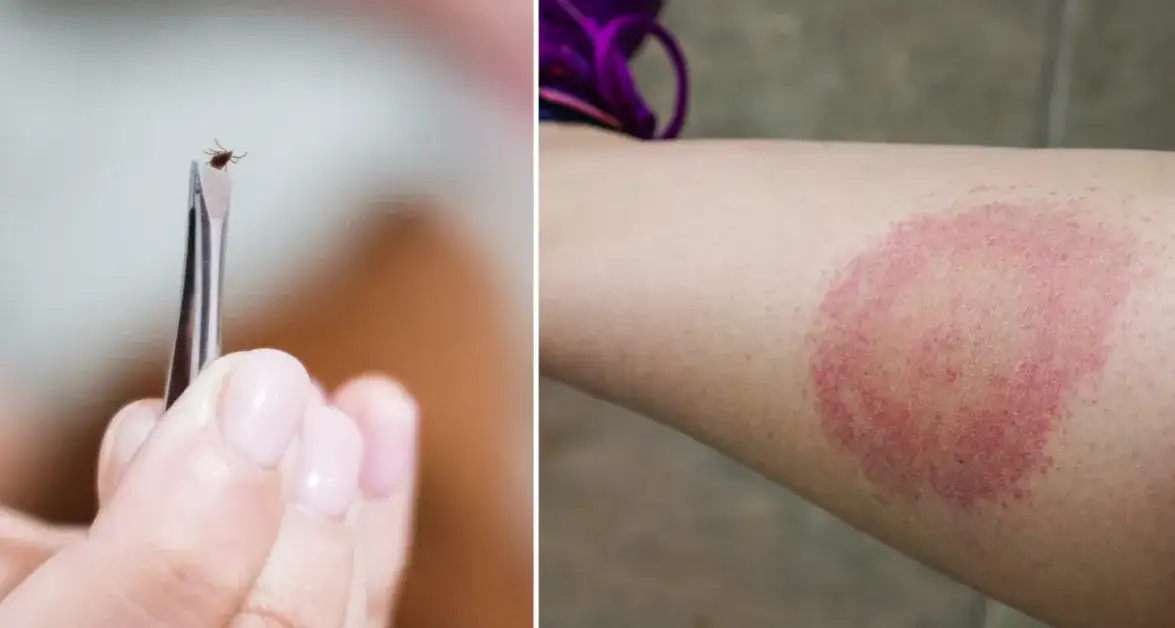 Borelioza objawy psychiczne: jak neuroborelioza wpływa na psychikę?