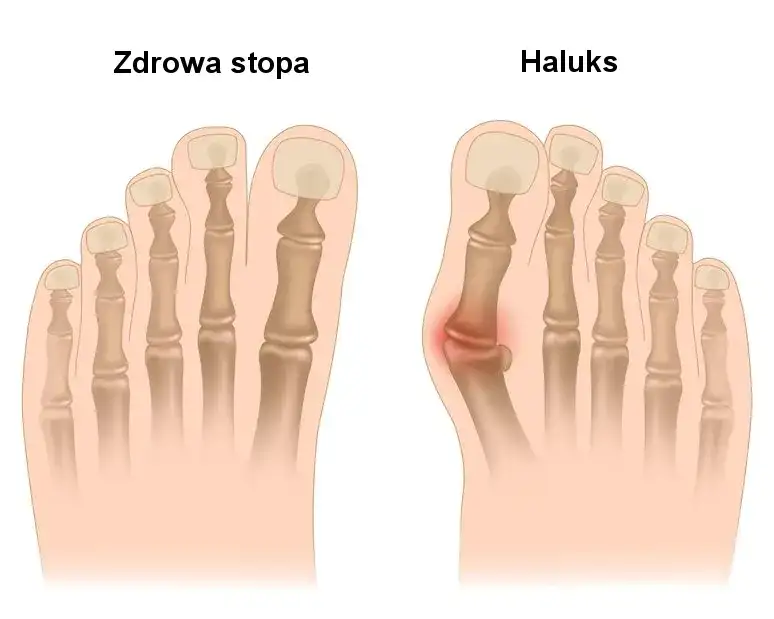 Ból haluksa: dlaczego stopa cierpi i jak znaleźć ulgę?