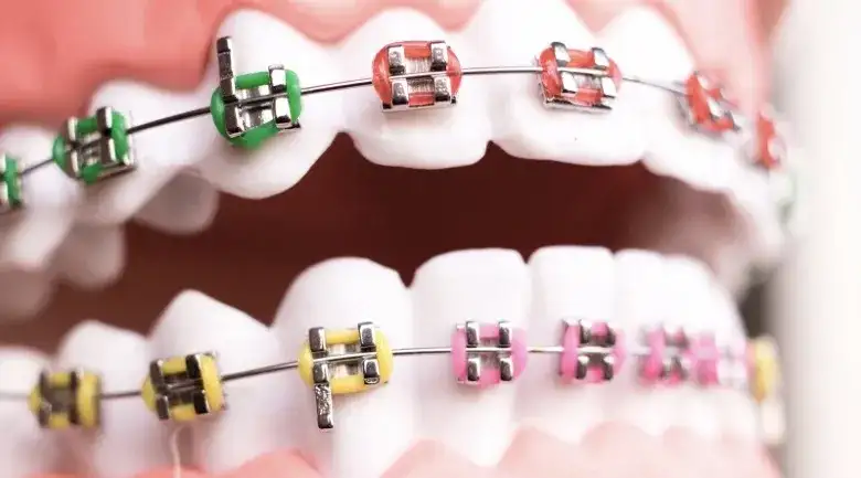 Jak działa aparat na zęby? Poznaj sekrety skutecznej ortodoncji