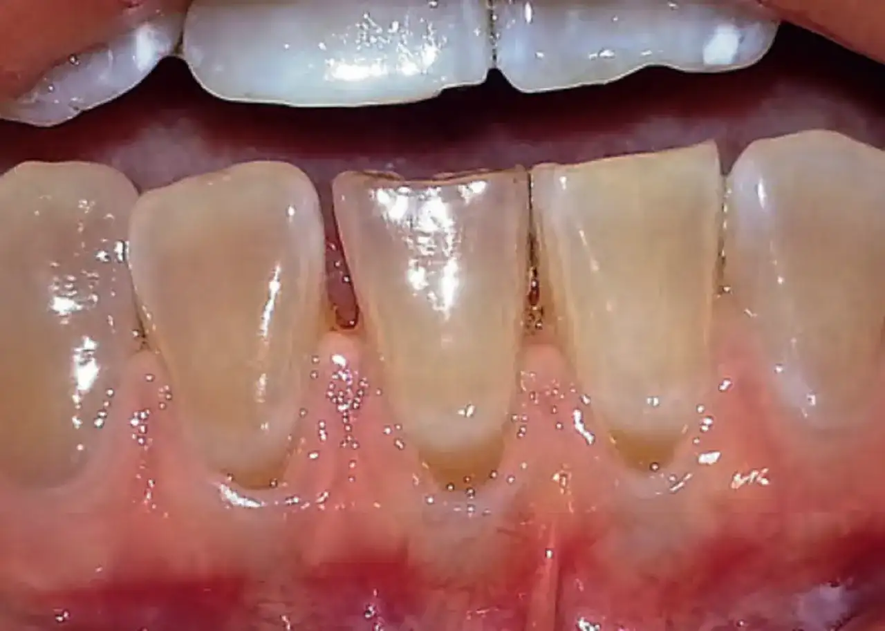 Przeszczep dziąsła: czy warto? Pełny przewodnik po zabiegu.