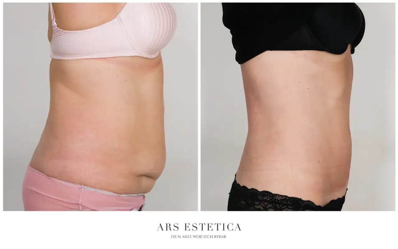 Liposukcja brzucha: Co to jest, dla kogo, efekty i cena?