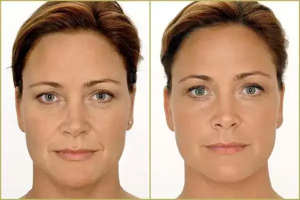 Zmarszczki palacza: Botox czy kwas hialuronowy - co wybrać?