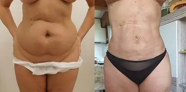 Liposukcja ultradźwiękowa ile zabiegów potrzebujesz, by schudnąć?