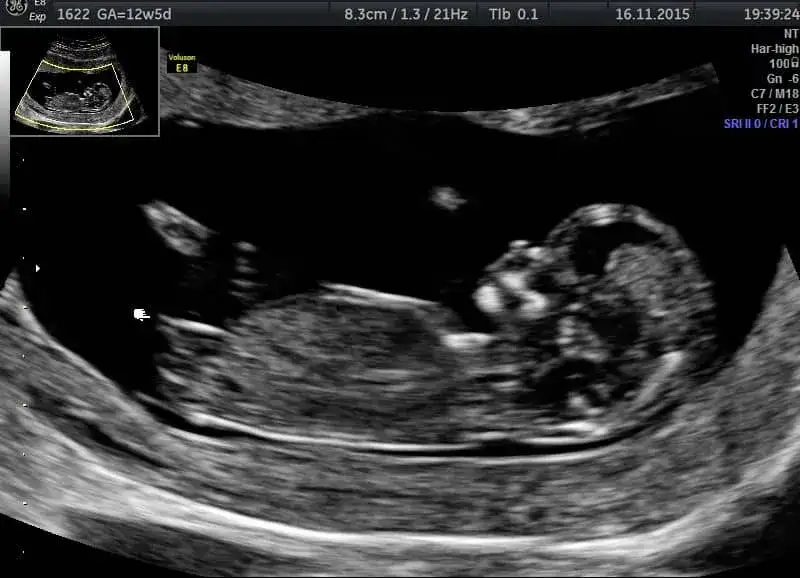 Jak wyglądają badania prenatalne w 13 tygodniu ciąży i co warto wiedzieć