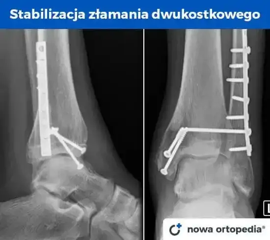 Złamana kość? Ile trwa rehabilitacja i jak wrócić do formy?