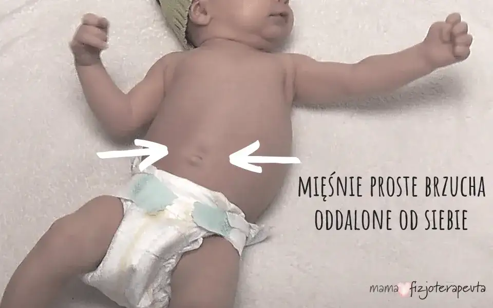 Rozejście mięśnia prostego brzucha u dziecka: objawy i leczenie.