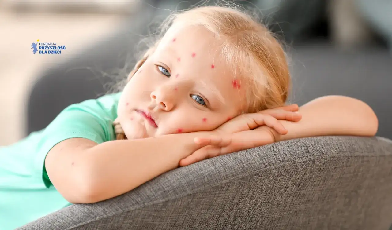 Ospa w przedszkolu co robić? Jak chronić dziecko i uniknąć problemów