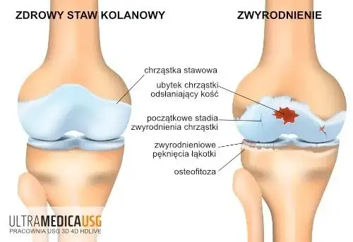 Choroba zwyrodnieniowa stawów: leki, suplementy i terapie. Co działa?
