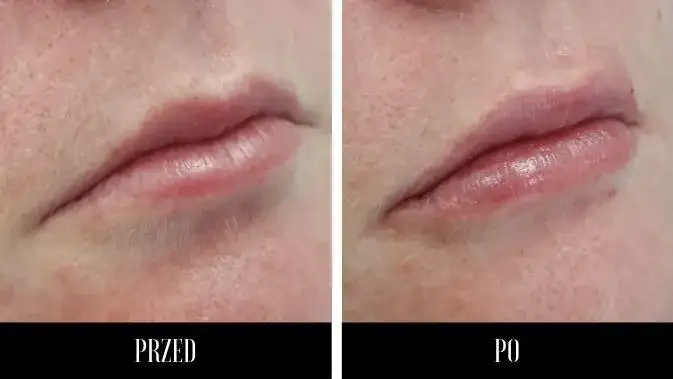 Powiększanie ust Lublin - gdzie najlepiej i co warto wiedzieć?