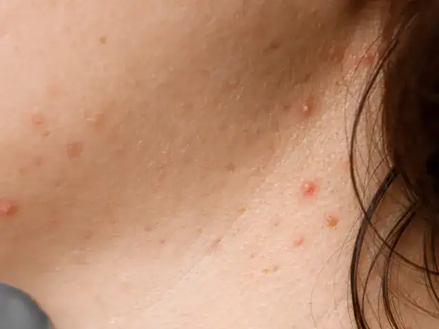 Pryszcze na szyi co oznaczają i jak skutecznie je leczyć