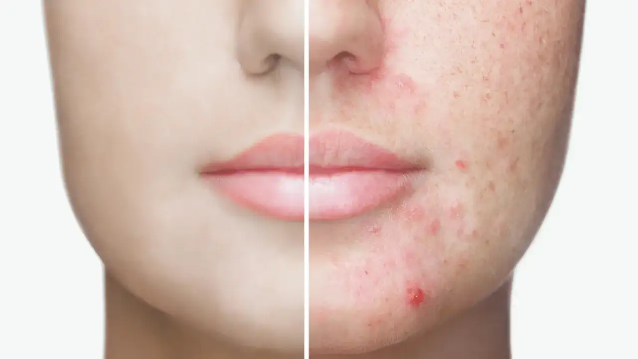 Pryszcze: Co naprawdę działa? Skuteczny plan pielęgnacji i leczenia
