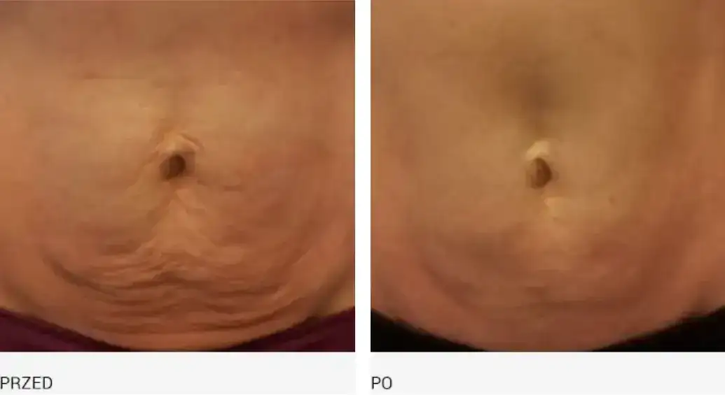 Endermologia jak długo utrzymują się efekty i co na nie wpływa?