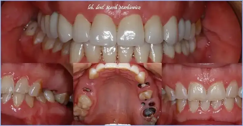 Leczenie kanałowe: Jak rozpoznać, że Twój ząb go potrzebuje?