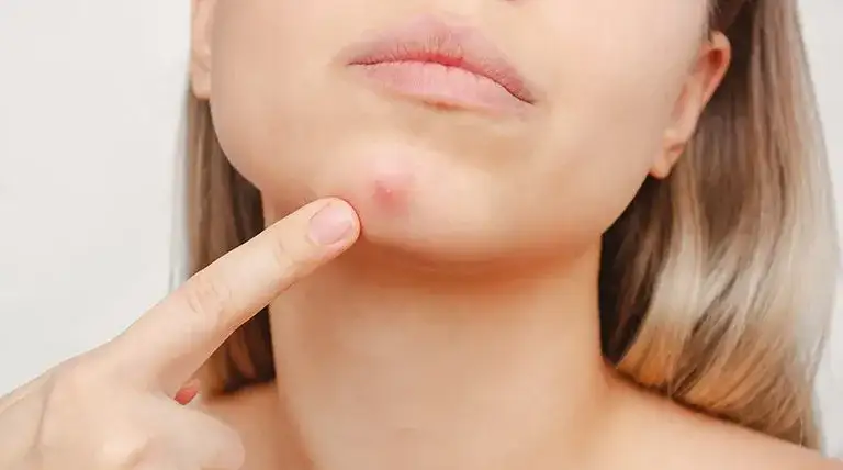 Jak pozbyć się pryszcza pod skórą? Skuteczne sposoby i porady