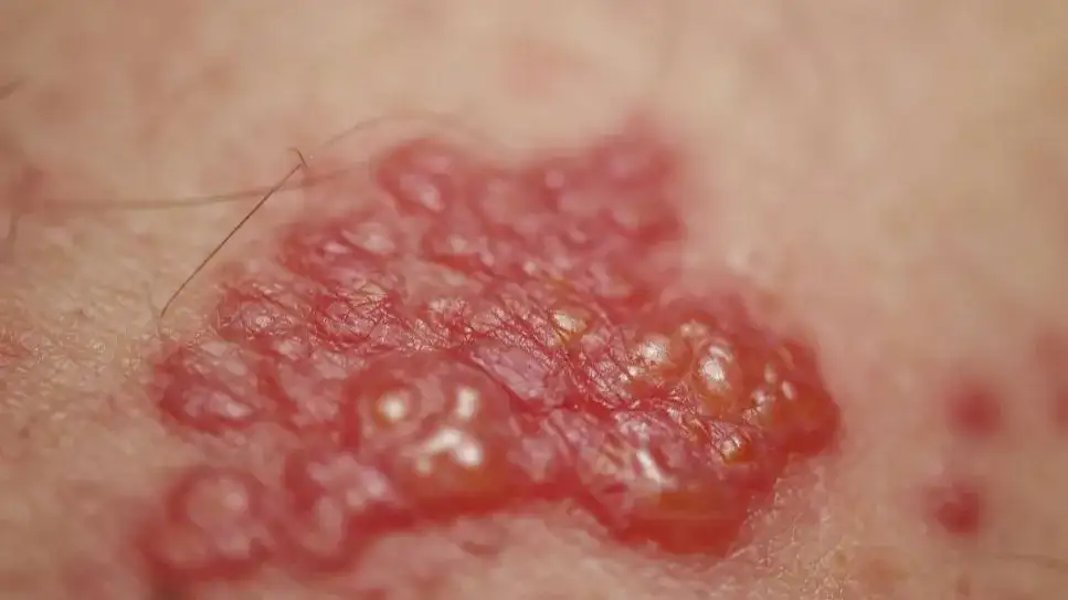 Gürtelrose Medikamente: Effektive Behandlungen und wichtige Hinweise