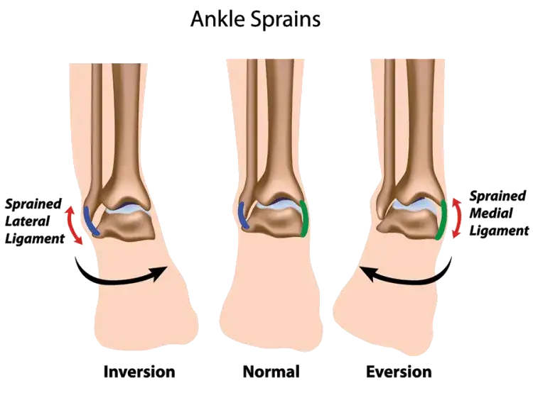 Skręcona kostka jak długo trwa leczenie i powrót do sprawności
