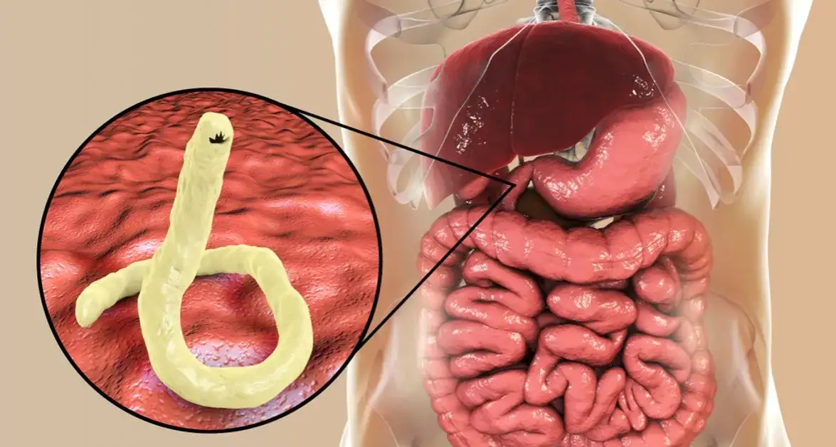 Przywra jelitowa: 5 alarmujących objawów i metody leczenia