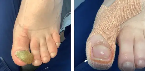 Twarde paznokcie u stóp: Zmiękcz je bezpiecznie! Dom, apteka, podolog.