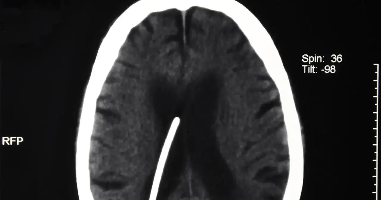 Wodogłowie u dorosłych objawy – jak je rozpoznać i uniknąć powikłań