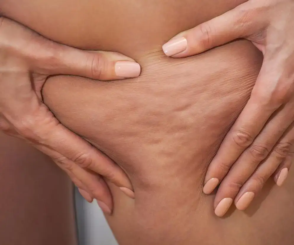 Jak pozbyć się cellulitu z ud? Skuteczne metody i porady eksperta