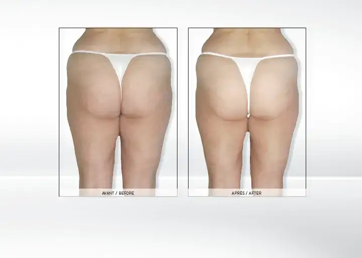 Endermologia: Kiedy efekty i jak utrzymać je na dłużej?