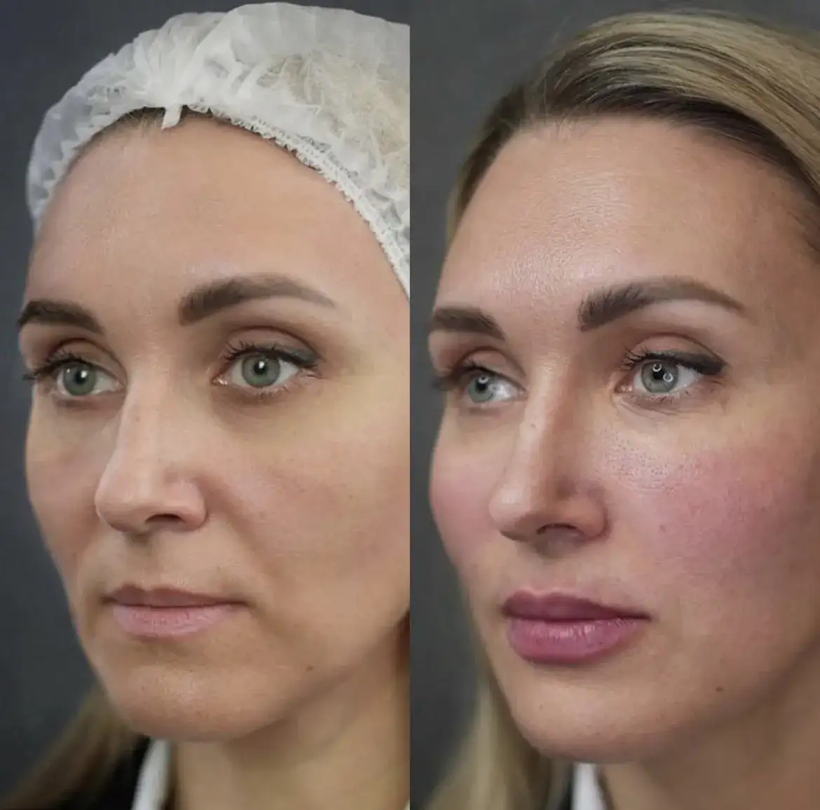 Botoks Warszawa: Jak wybrać klinikę? Bezpieczeństwo i efekty!