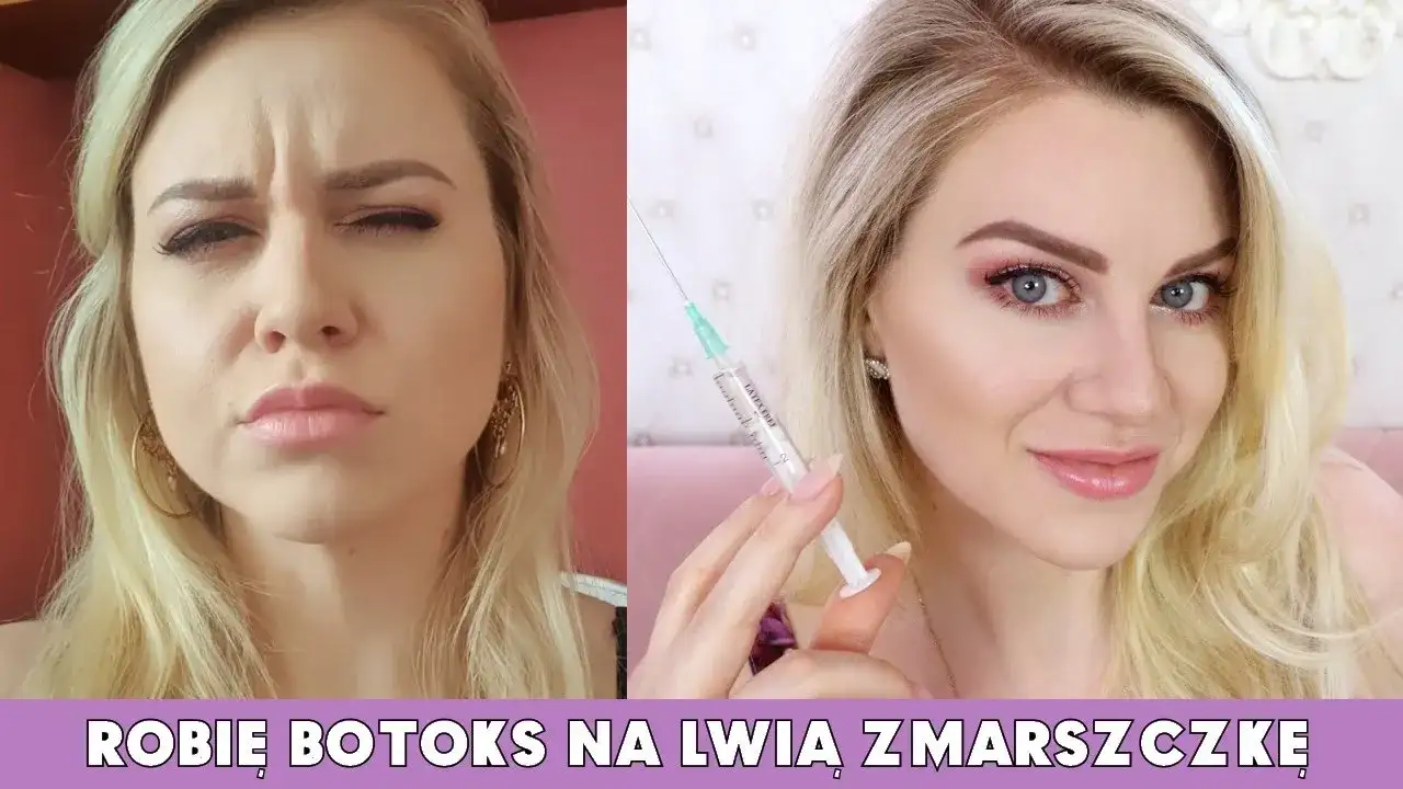 Ile kosztuje botoks na lwią zmarszczkę? Ceny w Polsce i ważne informacje