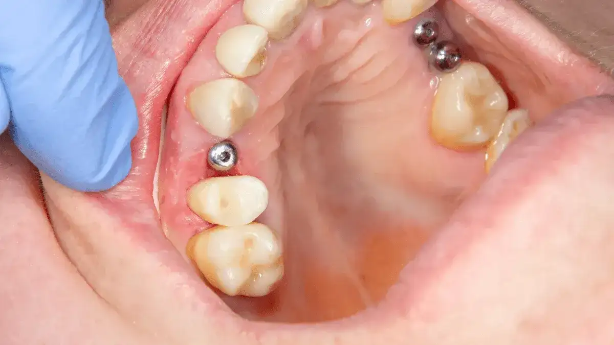 Implant zęba: Poznaj fakty! Zabieg, zalety, cena Twój nowy uśmiech